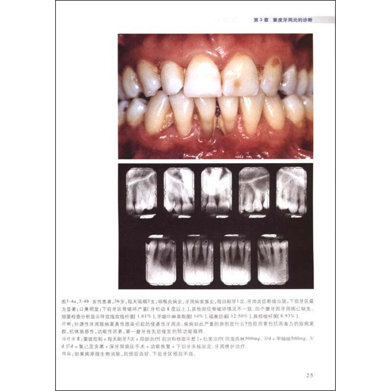 《口腔开业医师临床指导丛书:重度牙周炎冶疗