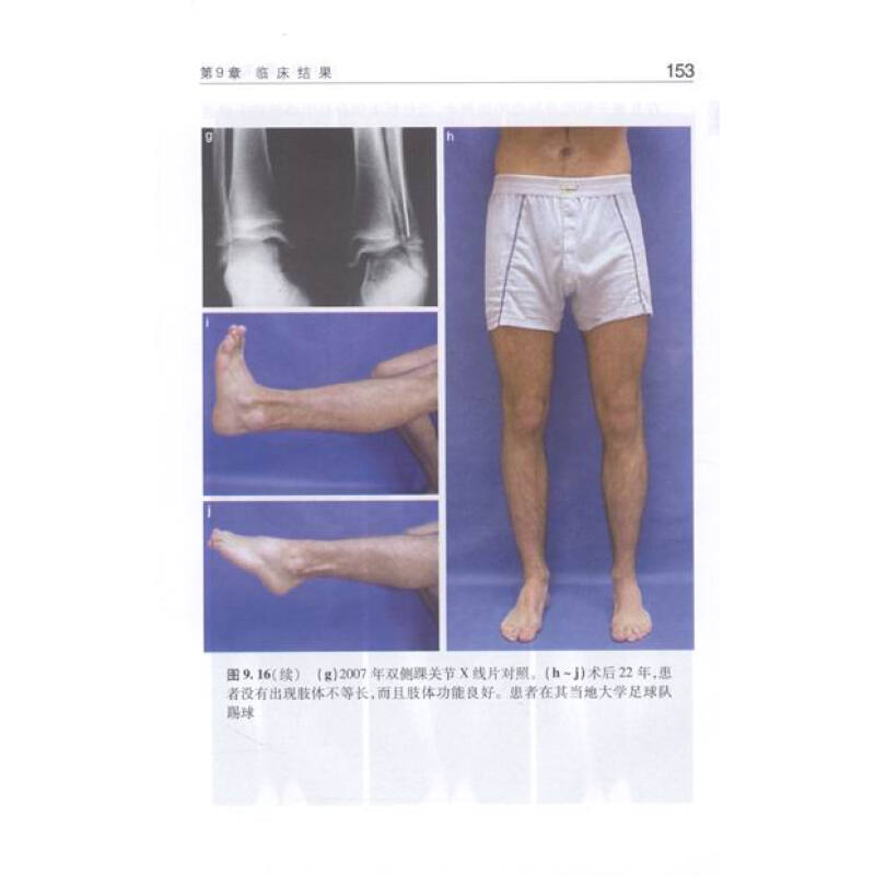 正版现货 儿童骨肿瘤 专著 pediatric bone sarcomas epiphysiolys