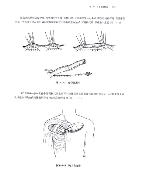 穿支皮瓣手术图解