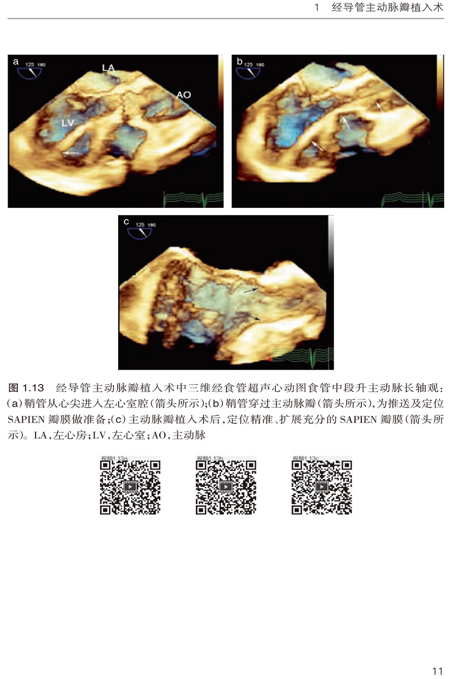 《现货 三维经食管超声心动图在结构性心脏病介入治疗中的应用 苏茂龙