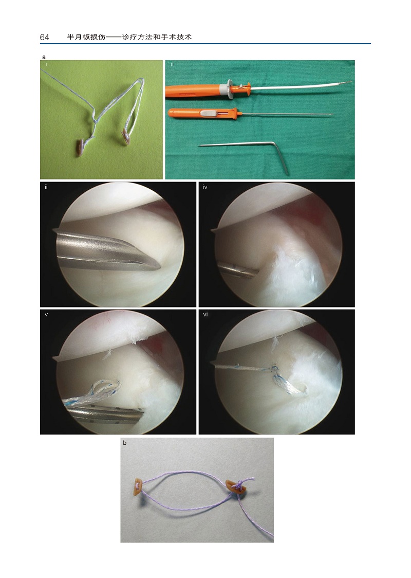 《半月板损伤 诊疗方法与手术技术 涵盖了半月板解剖,体格检查和基因