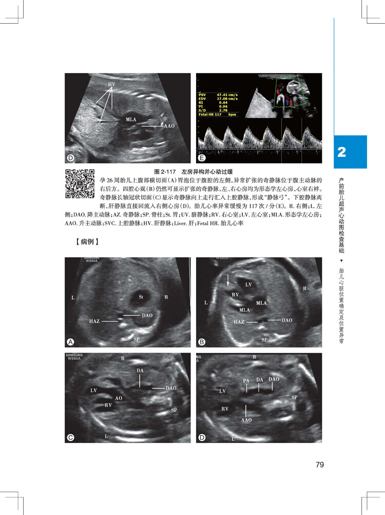 现货胎儿超声心动图实用手册第2版二配增值于岚人民卫生出版社