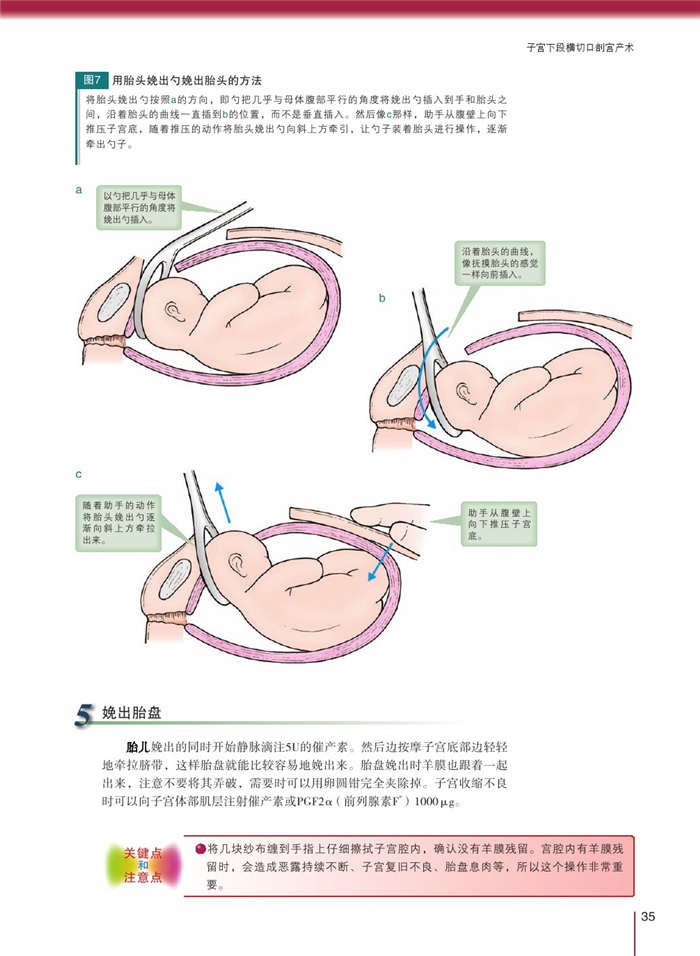 剖宫产术中合并子宫肌瘤患者150例临床处理分析