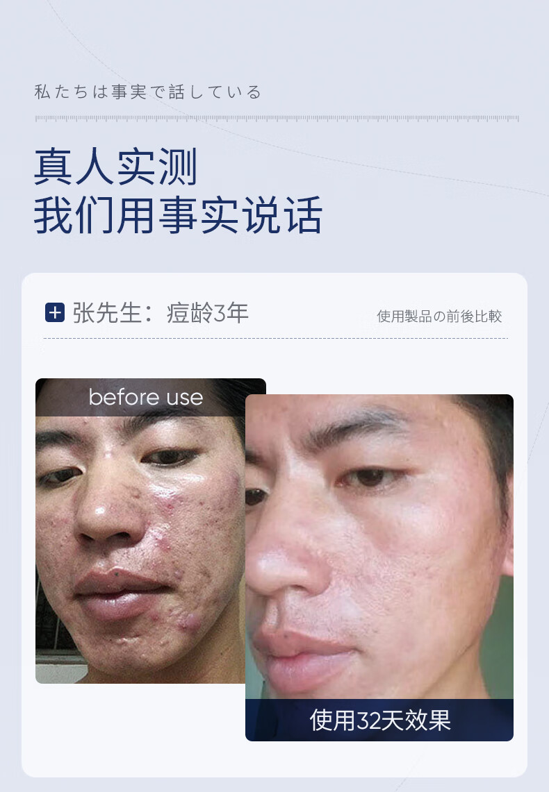 SUMDOY日本进口壬二酸祛痘印痘坑修复膏去痘红肿淡化痘印痘疤女男士 【94%顾客选择】周期修护60g