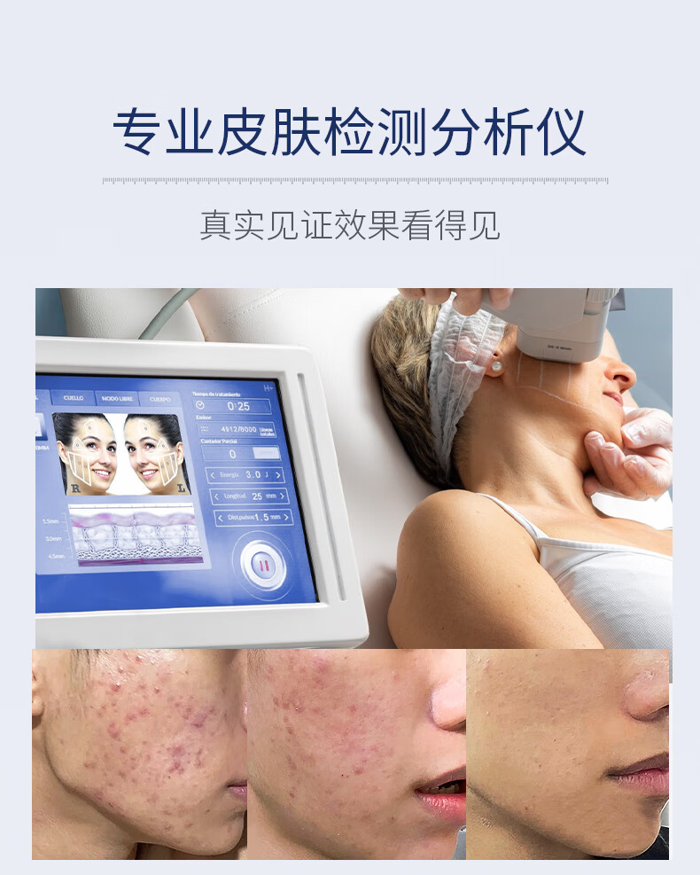 SUMDOY日本进口壬二酸祛痘印痘坑修复膏去痘红肿淡化痘印痘疤女男士 【94%顾客选择】周期修护60g