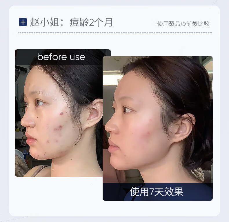 SUMDOY日本进口壬二酸祛痘印痘坑修复膏去痘红肿淡化痘印痘疤女男士 【94%顾客选择】周期修护60g