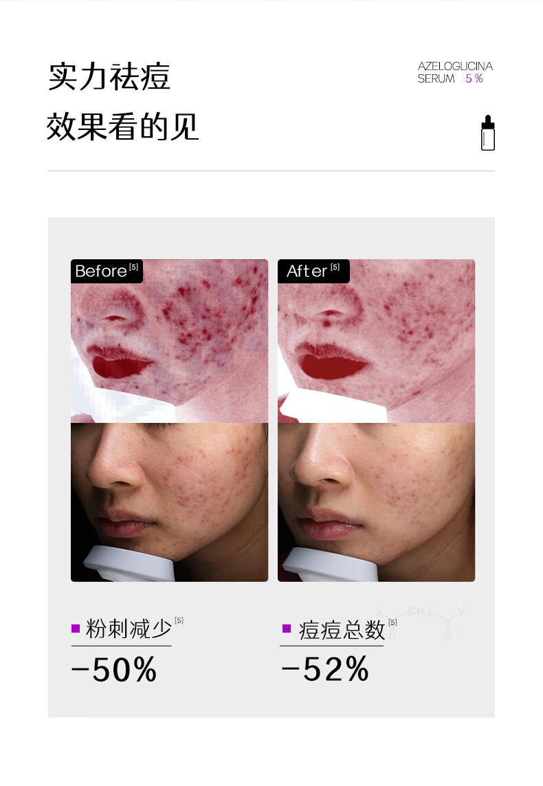 伊美莱 （E-MaidLand）杜鹃花酸原液 5%壬二酸祛痘精华液男女士护肤品 【杜鹃花酸原液30ml】