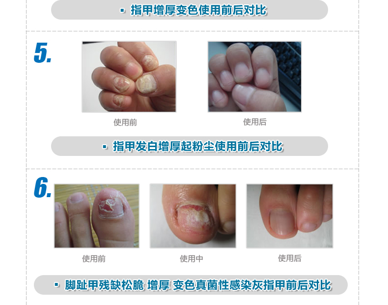 康本立特灰甲净治疗灰指甲特效药去灰指甲特效