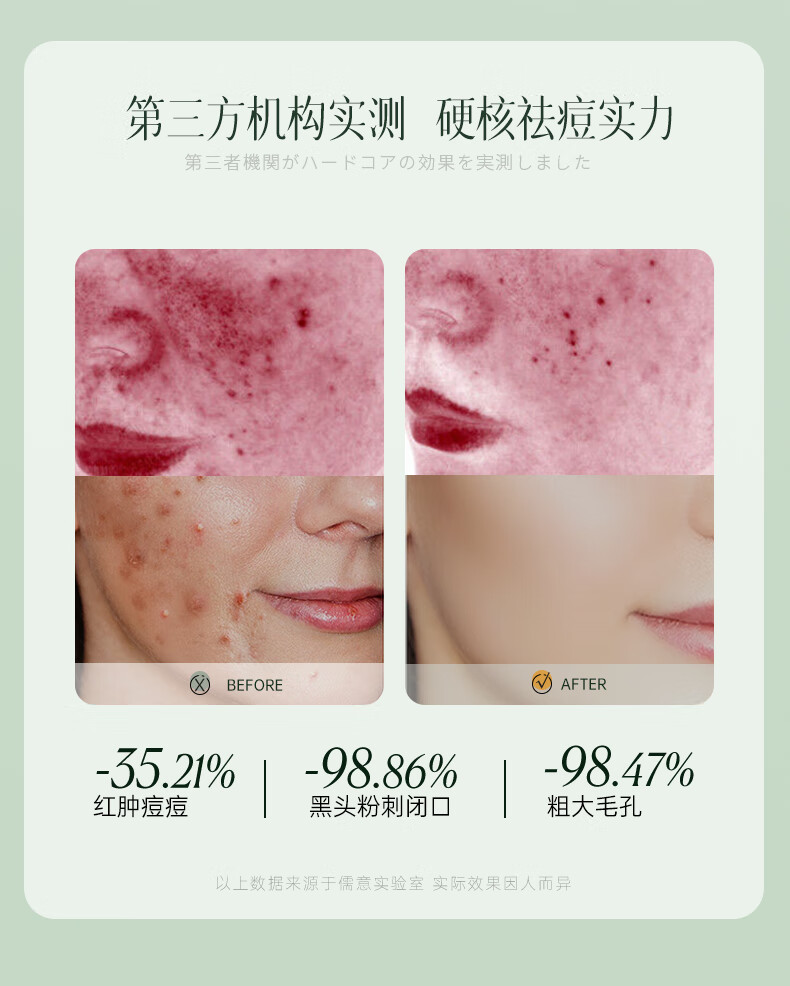 儒意水杨酸祛痘面膜淡化痘印补水保湿嫩白收缩毛孔控油修复男女士专用 25片赠3片【淡化红肿】祛痘消印