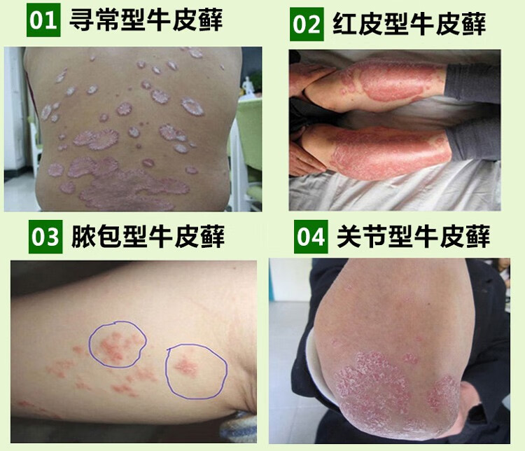 软膏股藓膏汗斑大腿内侧头苗药手足癣银屑病湿疹膏身上痘痘青春痘 肤