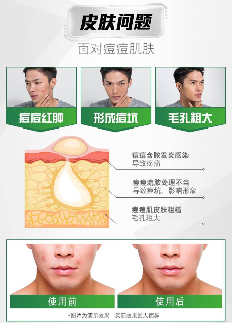 曼秀雷敦（Mentholatum） 控油抗痘洁面乳淡化痘印活力保湿男士洗面奶 冰爽活炭洁面乳150ml