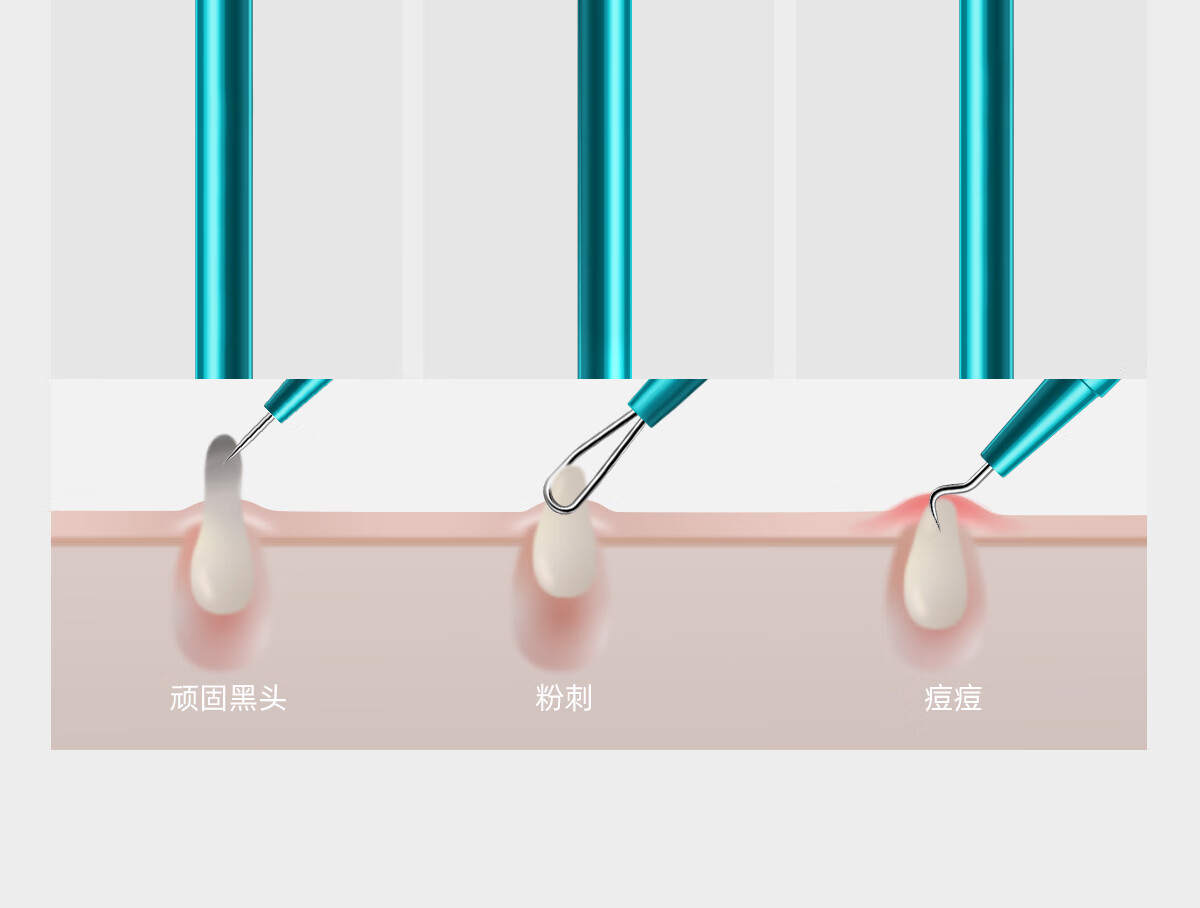 CARLI BYBEL细胞夹黑头超细专业清理工具去痘痘粉刺针斜嘴夹镊子针清超尖套装 【升级款】斜嘴夹