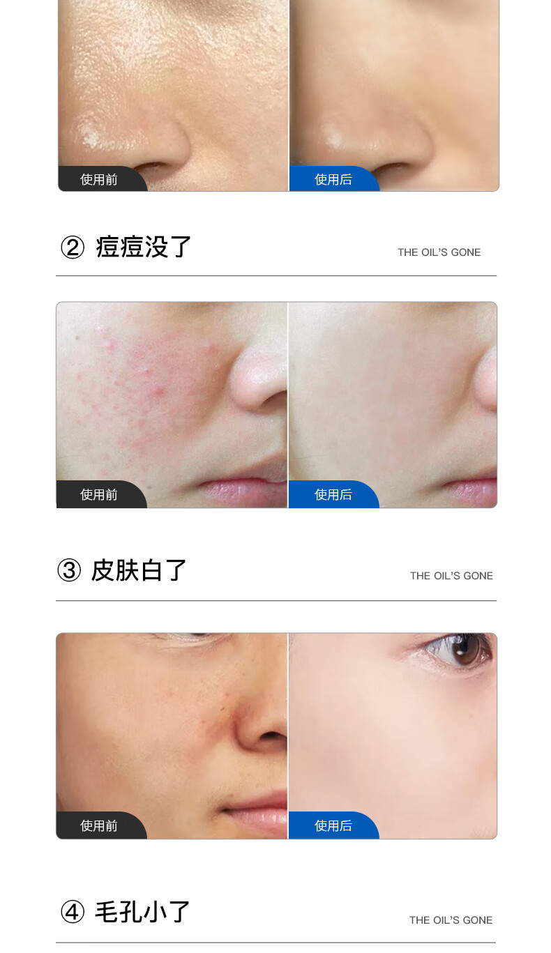 泊舒男女通用深层清洁控油抗痘洗面奶除螨虫洁面乳100g 控油祛痘