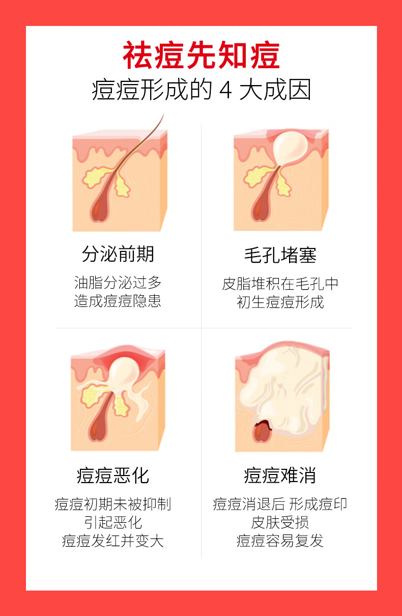 RYDEEN壬二酸祛痘膏凝胶淡化痘印痘坑青春痘成人痘粉刺黑头抗痘 1支