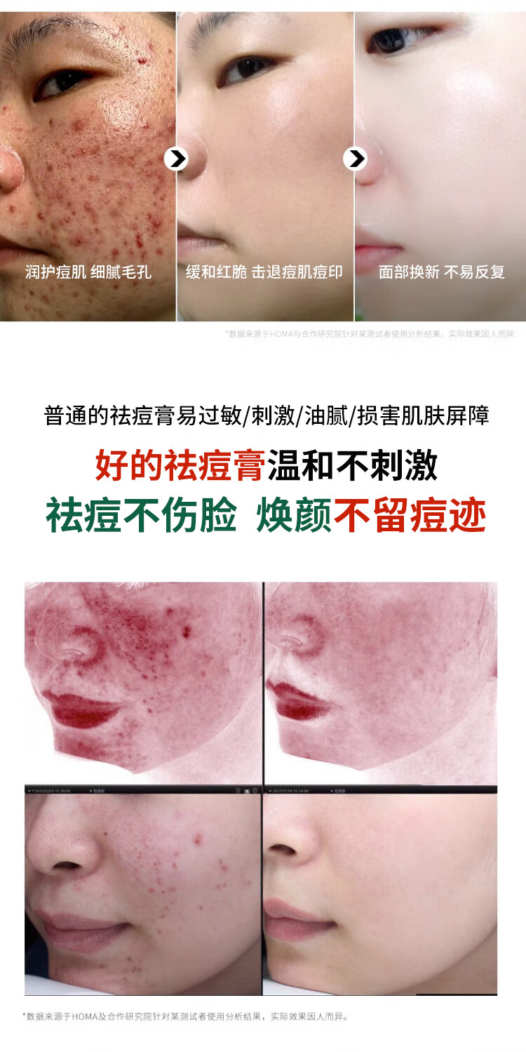 碧然堂草本祛痘膏40g痘疤痘印痘坑痘肌青春痘熬夜暗沉男女士学生护肤品 草本祛痘膏40g*1支