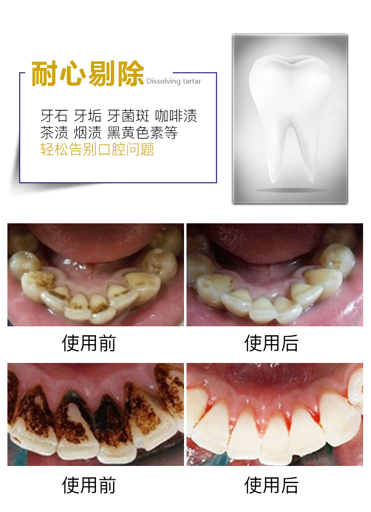 牙结石去除器牙齿清洁工具洗牙牙石清除剔牙神器牙垢牙镜子口腔镜国产