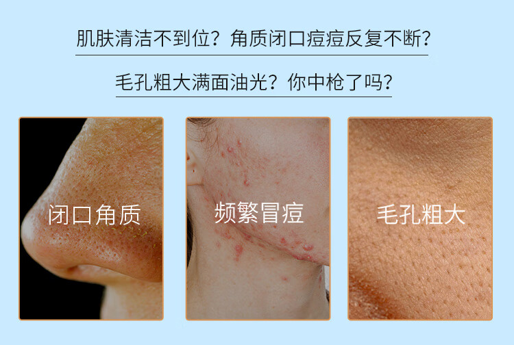 施颜适（Stridex）美国进口水杨酸净颜洁面控油祛痘闭口55片水杨酸棉片深层清洁毛孔 绿罐【新手型建议初次使用】