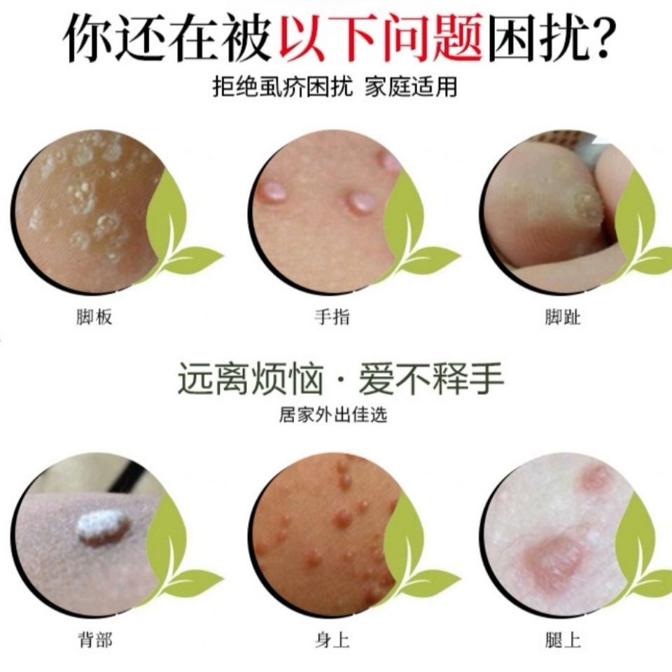 其它身体护理 苗先锋 苗先锋克疣液扁平尤去除膏点除一抹灵面部去猴子