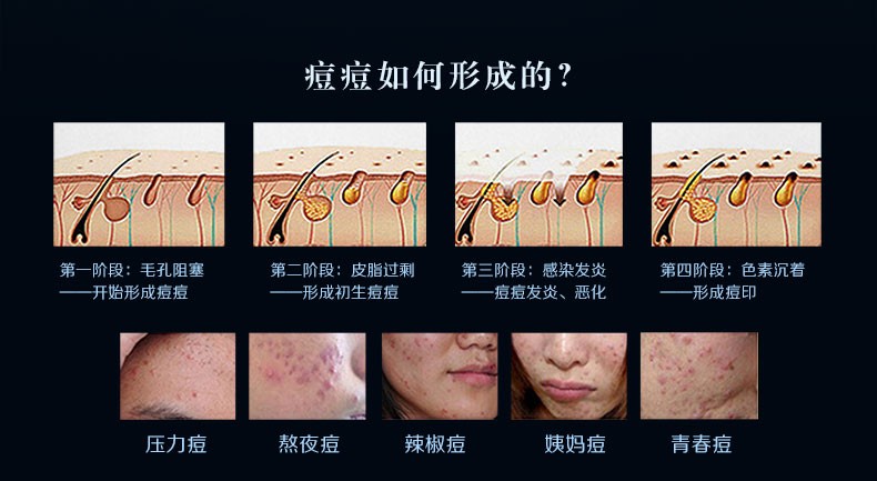 克林霉素磷酸酯外用溶液20ml用于治疗寻常痤疮痘痘粉刺jt3盒1包棉签