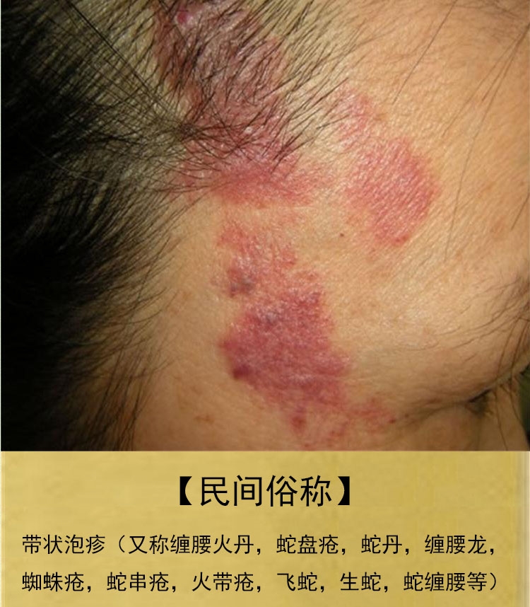 【顺丰发货】蛇盘膏生蛇皮肤带状泡疹胆疮蛇缠腰龙后遗症浅米胡克蛇