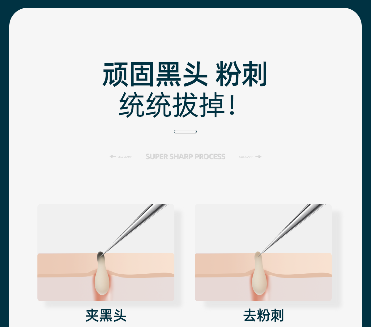 欧亿姿（oeiez） 5号超尖细胞夹美容院专用祛黑头夹暗疮针超细粉刺针套装挑痘工具 超尖细胞夹【0.1mm】三只组合装