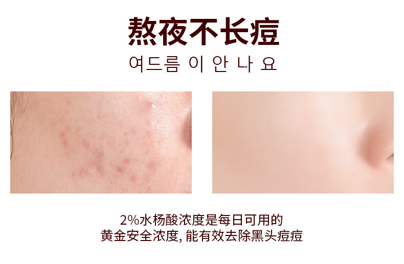 Tondi水杨酸精华液净痘痘淡化痘印痘疤粉刺闭口面部精华青春痘护肤品 30ml