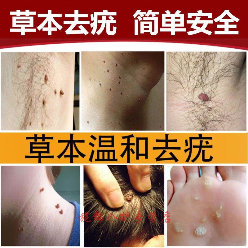 疣液克优液治扁平忧肉粒去手脚掌心肉猴子克忧王无痕外用用擦净