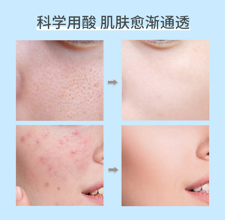 施颜适（Stridex）美国进口水杨酸净颜洁面控油祛痘闭口55片水杨酸棉片深层清洁毛孔 绿罐【新手型建议初次使用】