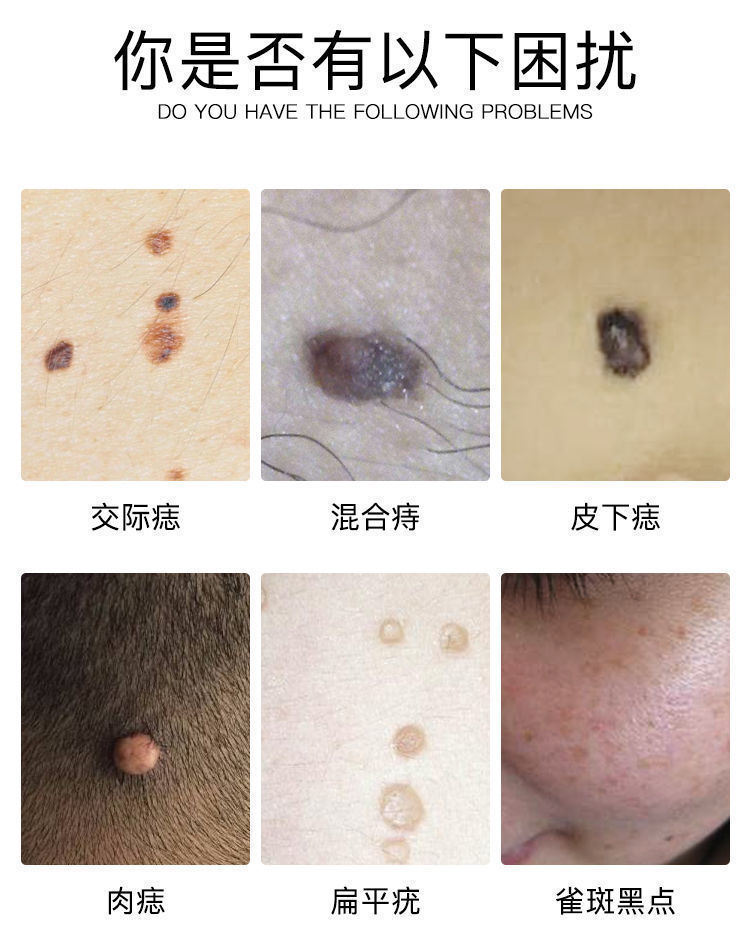 【去黑点】祛痣灵祛痘印无痕点痣膏产品去黑色素黑痣