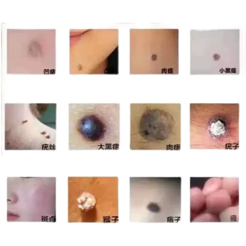 唯芙去痣点痣膏无痕家用祛痣神器点斑疣痦子黑点痣水仪