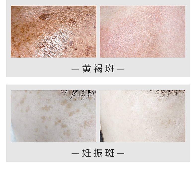 祛斑美白霜30g 改善净白透亮贵妇雀斑黄褐斑老年斑男女士淡化黑色素精华产品 1盒装