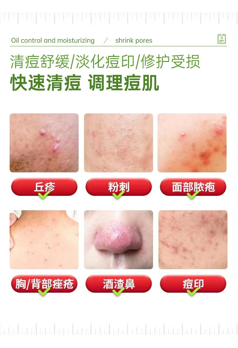 珂语（KEYU） 清痘调理凝胶焕颜祛痘精华净粉刺修护痘肌控油收敛毛孔 清痘调理凝胶1盒6支