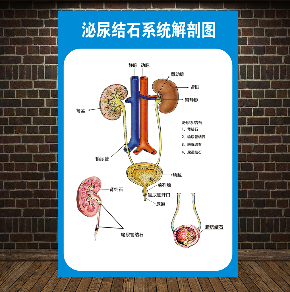 肾结石泌尿结石解剖图医学宣传挂图人体器官结构图医院海报墙贴纸泌尿