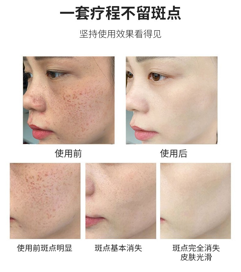 祛斑美白霜30g 改善净白透亮贵妇雀斑黄褐斑老年斑男女士淡化黑色素精华产品 1盒装