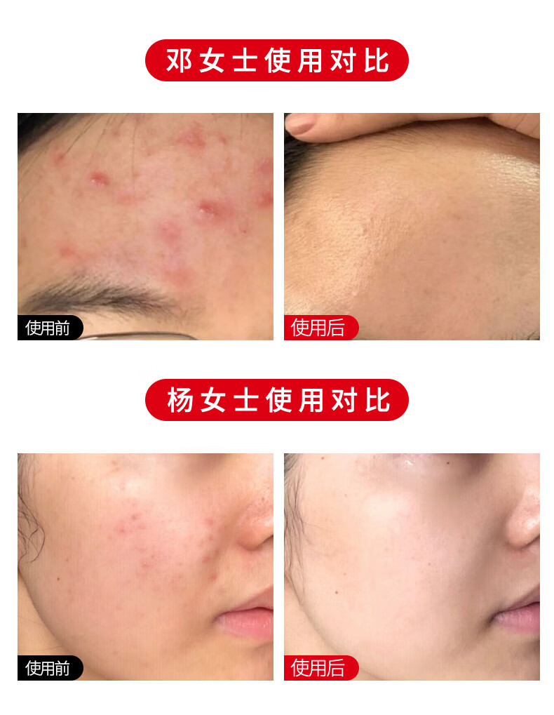 RYDEEN壬二酸祛痘膏凝胶淡化痘印痘坑青春痘成人痘粉刺黑头抗痘 1支