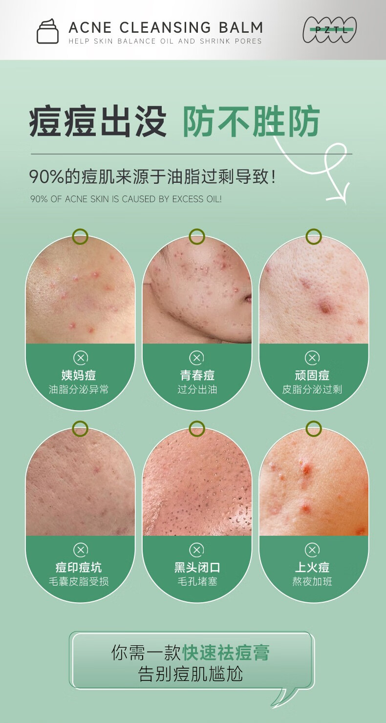 泊紫汀兰（Pozitilan）祛痘膏淡化痘印修复痘肌去痘坑闭口青春粉刺男女士壬二酸收缩毛孔 [轻度痘痘]30g