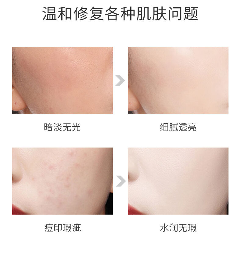 AHC爽肤水男大绿水大瓶湿敷水女补水闭口粉刺痘痘缩毛孔深度清爽控油 300ml（一瓶）