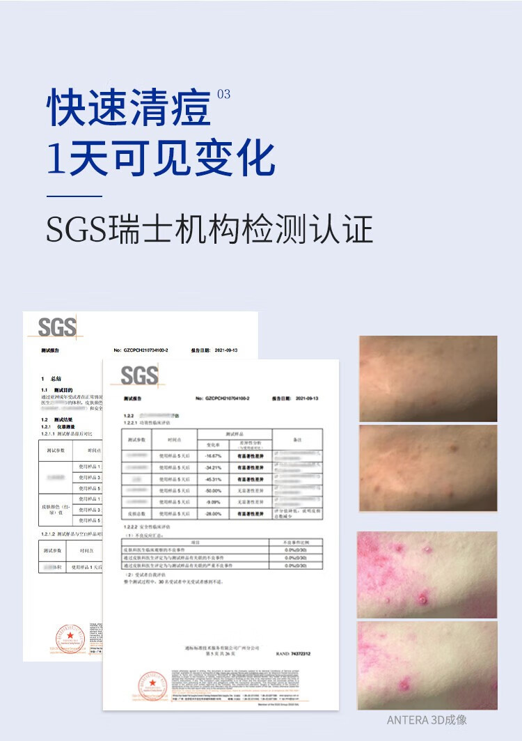 大水滴3点祛痘精华液姨妈痘紧急祛痘淡化痘印熬夜男女学生青春痘 祛痘精华 10ml 【升级版2.0】