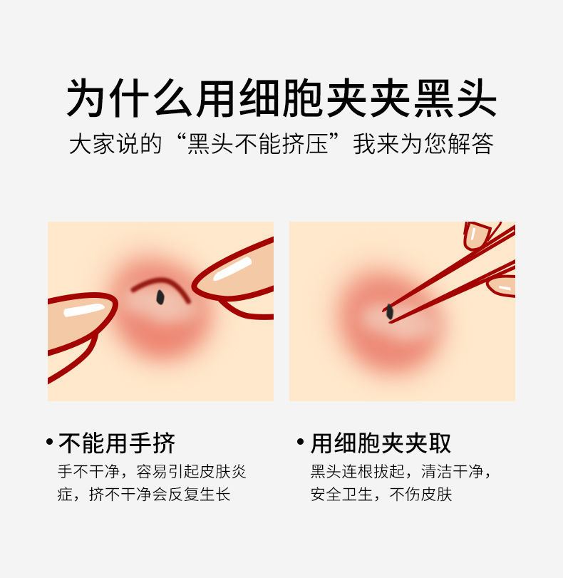 TETING 特婷超尖5号粉刺针细胞夹美容院镊子挤痘针去黑头闭口暗疮针祛痘 超尖5号斜夹+弯夹