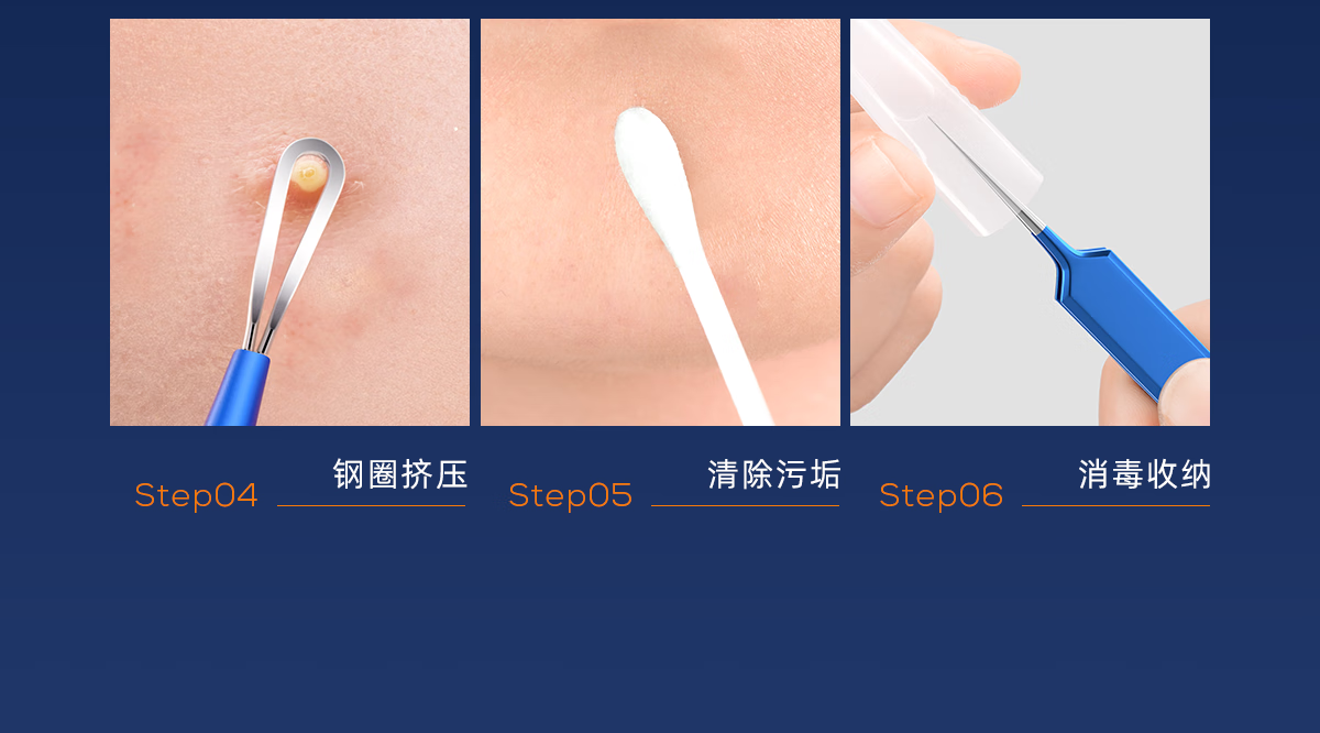 欧亿姿粉刺针套装细胞夹套装镊子祛黑头针粉刺痘痘超尖不锈钢美容院专用 尖嘴夹【单支套盒装】 #51