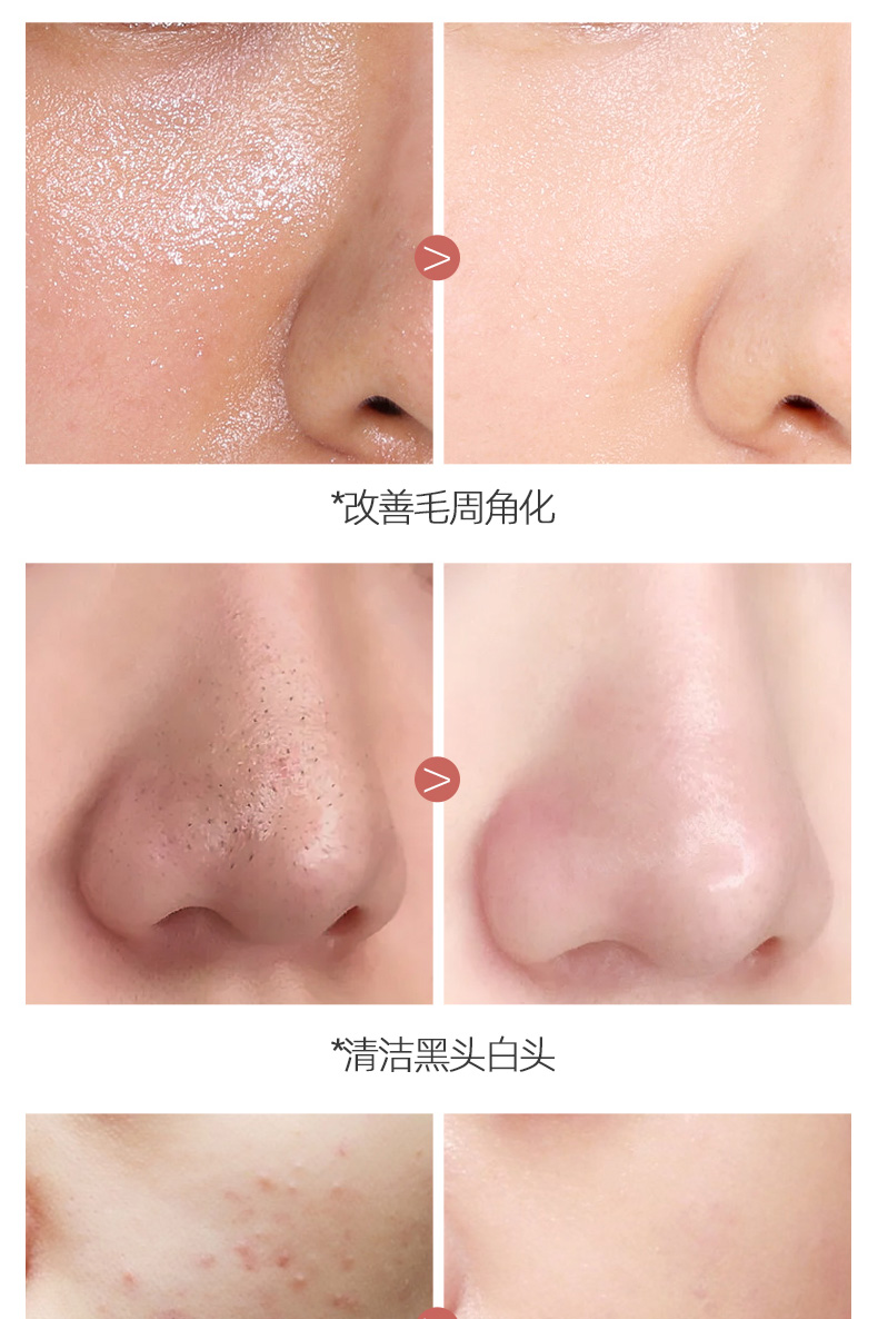 毛孔橡皮擦！排出脏东西 比水杨酸更好用 果酸去角质面部女去死皮男全身可用洁面乳 2盒装【实发3盒，第3盒0元】