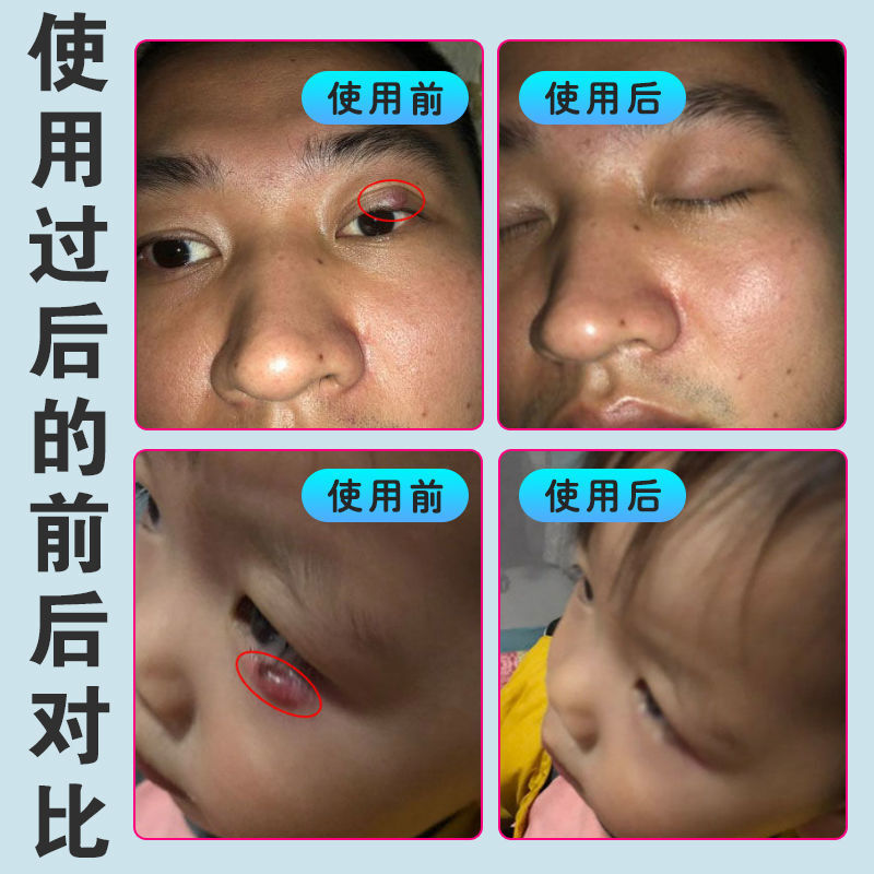奔泰hb麦粒肿睑腺炎决明子眼水15ml一盒装