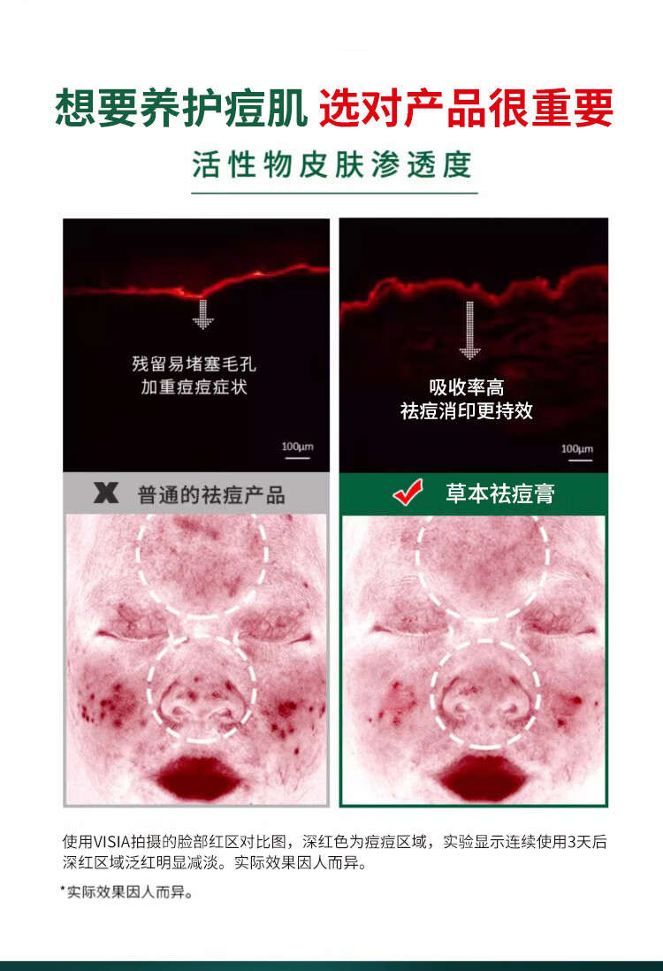 碧然堂草本祛痘膏40g痘疤痘印痘坑痘肌青春痘熬夜暗沉男女士学生护肤品 草本祛痘膏40g*1支