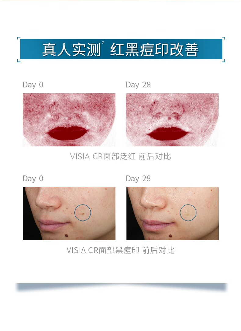 肌漾3.0修印精华淡化红黑痘印烟酰胺源头阻黑改善油痘肌 修印精华3.030ml