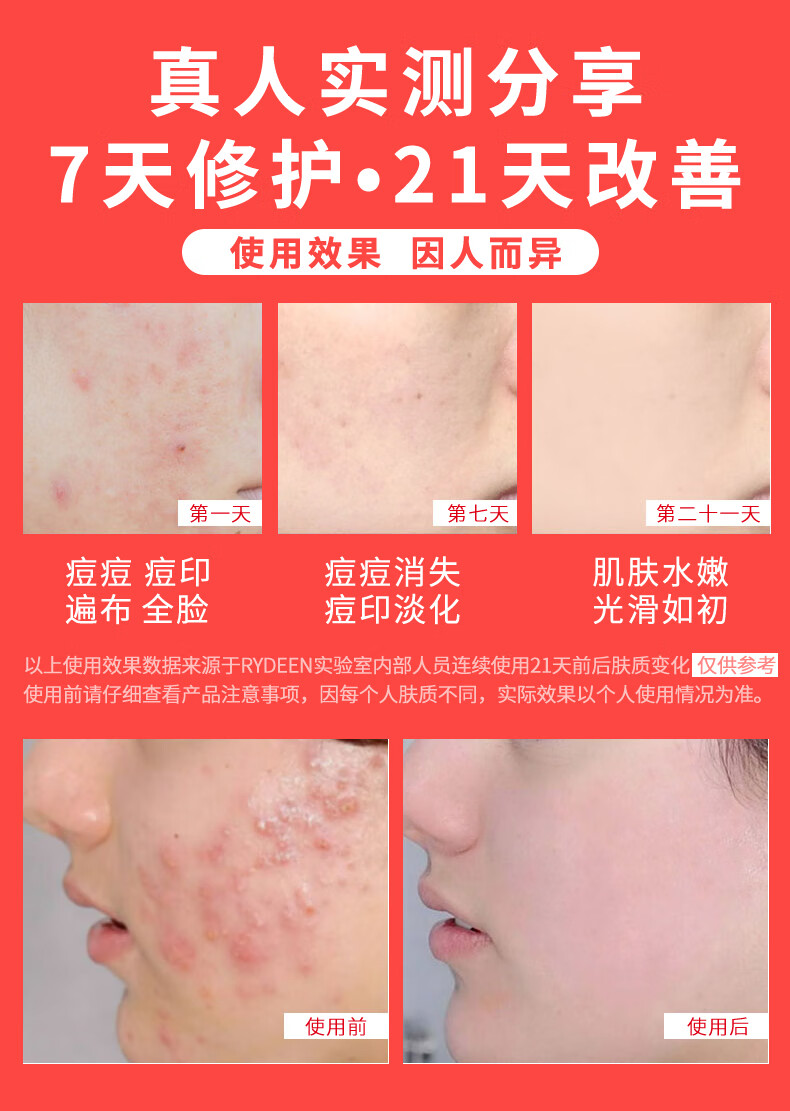 RYDEEN壬二酸祛痘膏凝胶淡化痘印痘坑青春痘成人痘粉刺黑头抗痘 1支