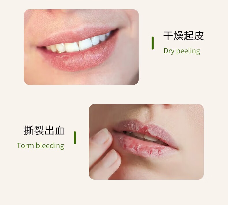 艾芭薇唇炎唇膏口角修护嘴唇部干裂开裂脱皮去角质烂嘴角痒护唇裂膏 唇膏买2鎹1 20g