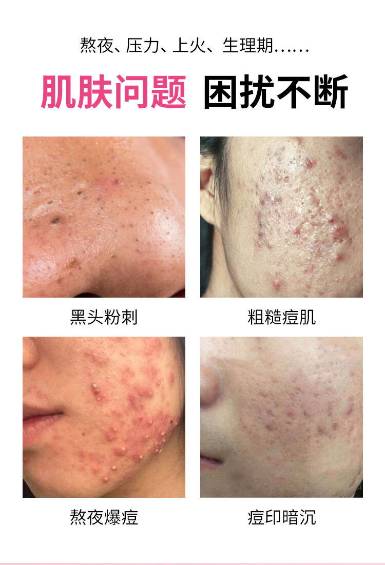 翼颜15%壬二酸凝胶软膏精华凝露水杨酸保湿痘痘肌肤痘坑痘印可用乳膏 15%壬二酸凝胶x1盒