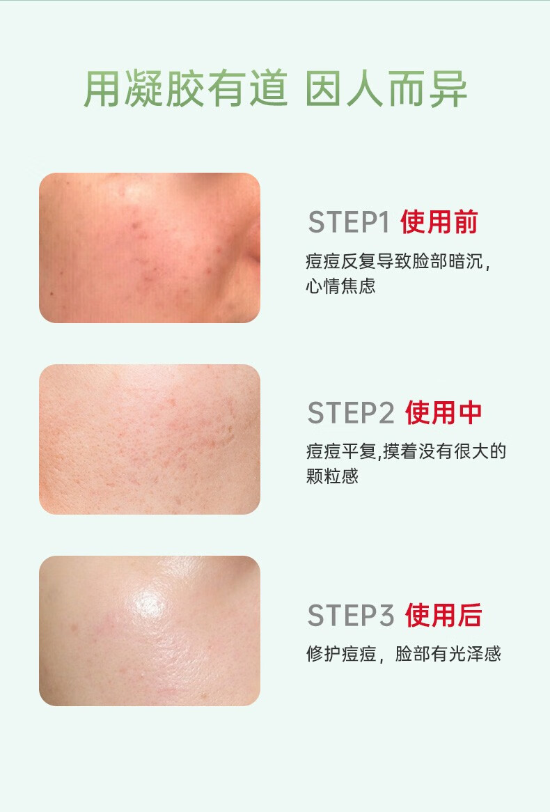 珂语（KEYU） 清痘调理凝胶祛痘清痘净粉刺修护痘肌控油收敛毛孔改善肌肤 1盒(6支装)