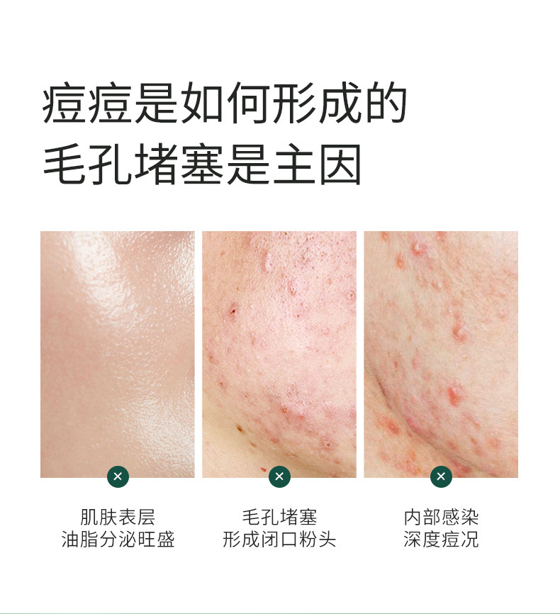 碧素堂（BISUTANG） 茶树祛痘膏控油祛痘淡化痘印粉刺草本植物滋润保湿护肤亮肤男女学生 祛痘膏1支(限时活动：下单发2支)