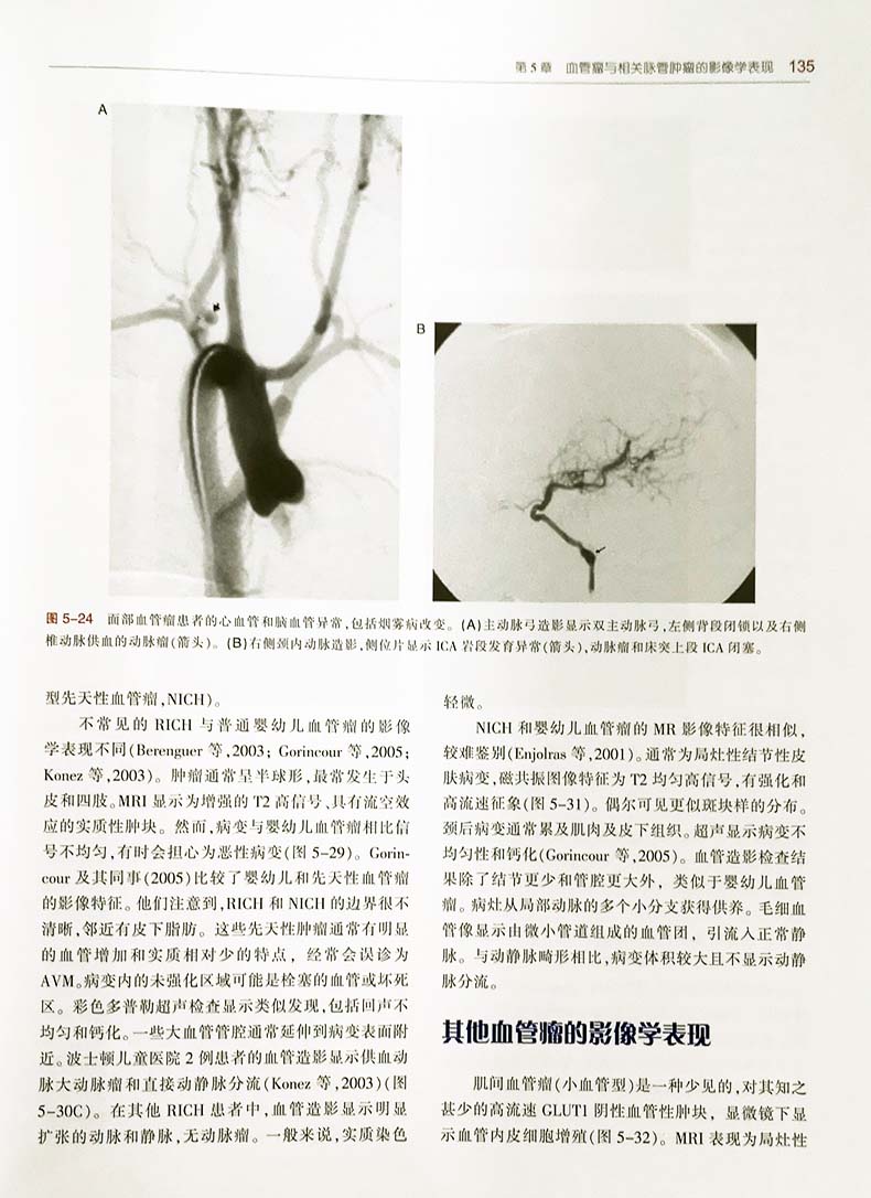 mulliken&young脉管疾病 血管瘤和脉管畸形 第二2版 郑家伟 范新东